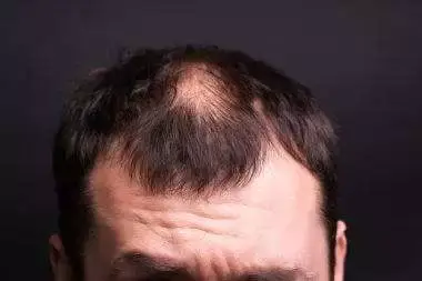 Alopecia Areata treatment in Ahmedabad